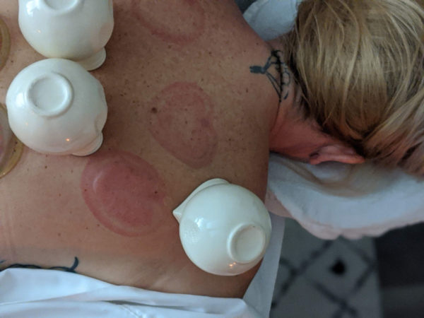 cupping on woman's back